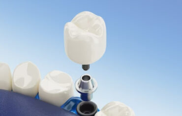 Dental Crown & Bridge