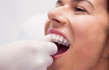 Clear Aligners Invisalign