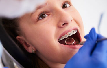 Dental Braces