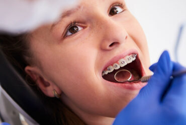Dental Braces