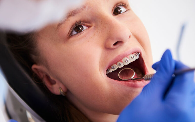 Dental Braces in Gandhinagar | Braces for Teeth Alignment - Nova Dental