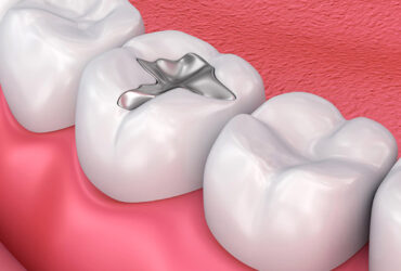 Dental Fillings