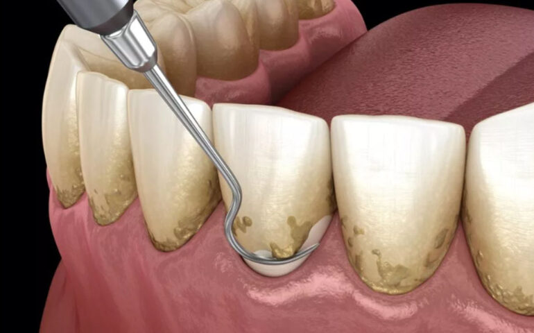 Gum-Disease-Treatment-in-Gandhinagar