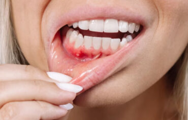 Gum Infection Treatment