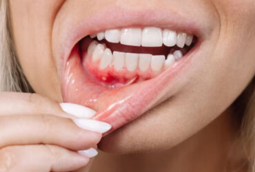 Gum Infection Treatment