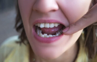 Misaligned Teeth Treatment