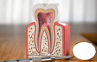 Painless Root Canal Treatment (RCT)