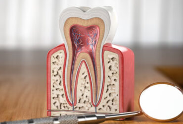 Painless Root Canal Treatment (RCT)
