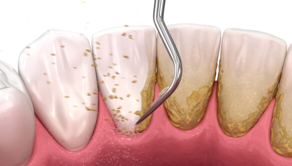 Confused Between Teeth Cleaning and Teeth Whitening? Here’s What You Need to Know