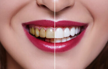Laser Teeth Whitening