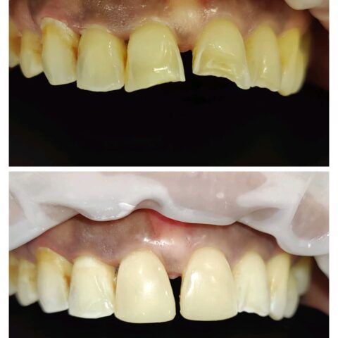 Composite veneers in gift city - Gandhinagar