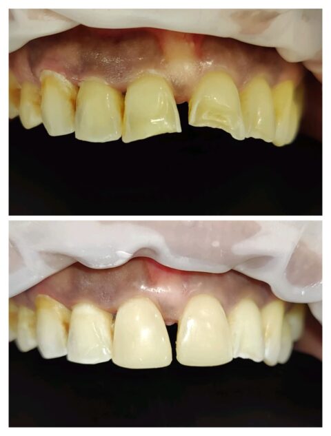 Composite veneers in gift city - Gandhinagar