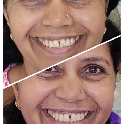 Composite veneers near PDPU
