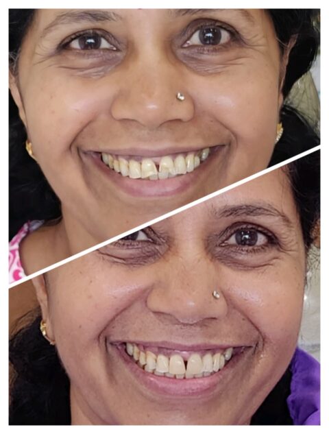 Composite veneers near PDPU