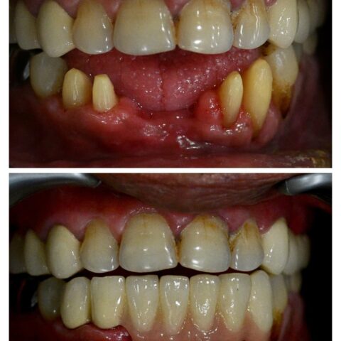 Dental crowns in gandhinagar- dental bridges in gandhinagar