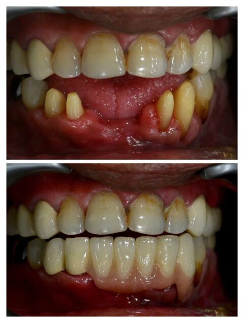 Dental crowns in gandhinagar- dental bridges in gandhinagar