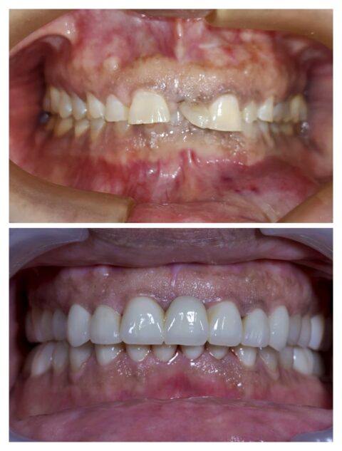FULL MOUTH Rehabilitation in gandhinagar