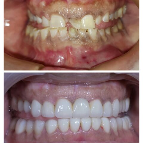 FULL MOUTH Rehabilitation near PDPU - Gift city