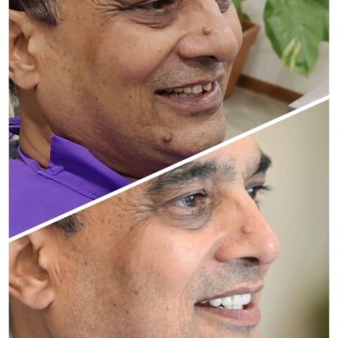 Premium Zirconia Crowns in Gandhinagar