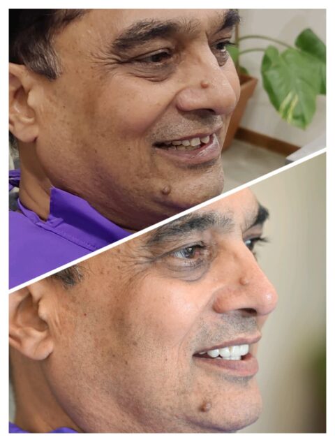 Premium Zirconia Crowns in Gandhinagar