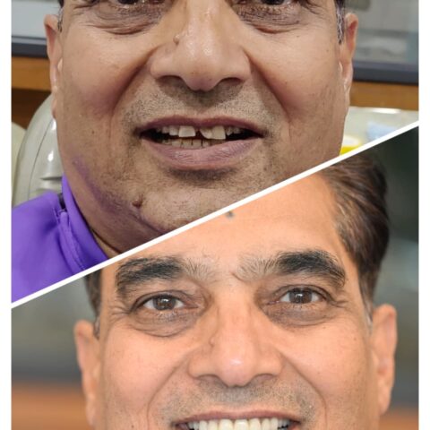 Premium Zirconia Crowns in Gift city and PDPU