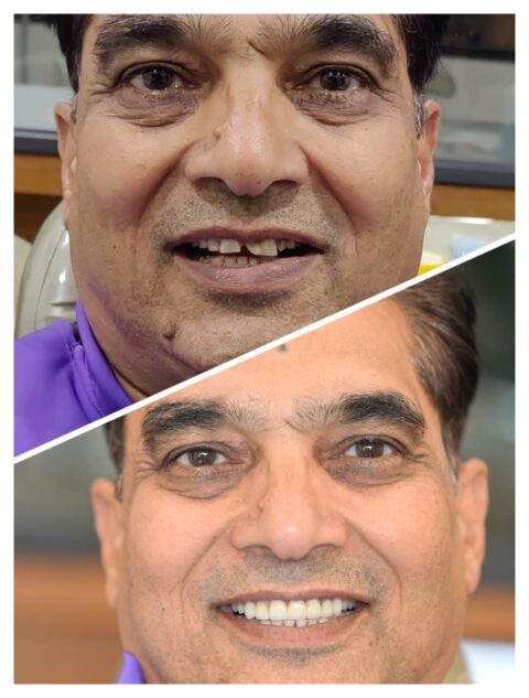 Premium Zirconia Crowns in Gift city and PDPU