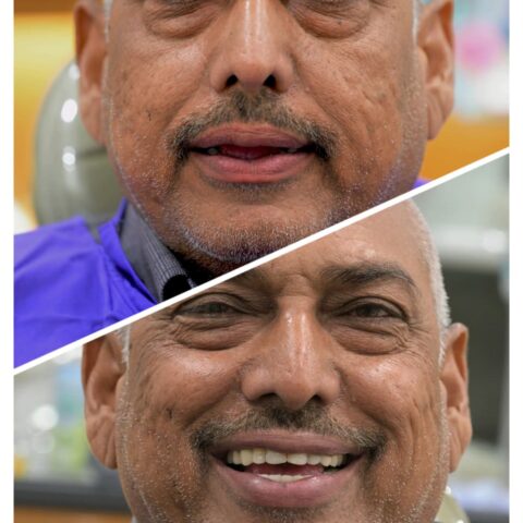 dental bridges in gandhinagar-dental crowns in gandhinagar