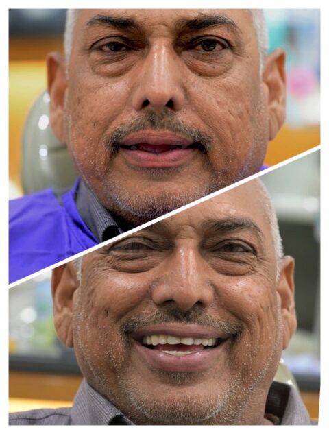 dental bridges in gandhinagar-dental crowns in gandhinagar