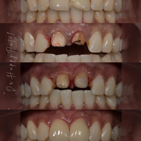 dental crown in gandhinagar