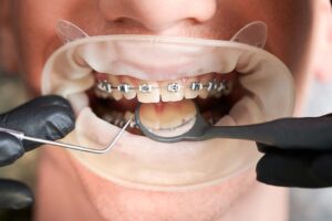 Dental Braces Treatment and Why it is important???
