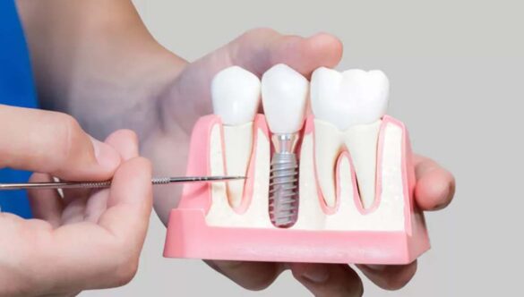 Having fear of dental implants?