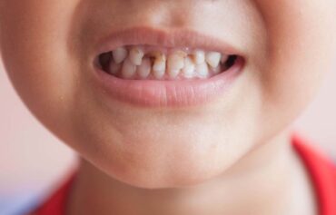 Cavity Protection Treatment