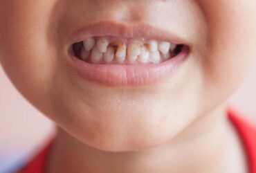 Cavity Protection Treatment