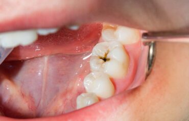Dental Cavity & Tooth Decay Treatment