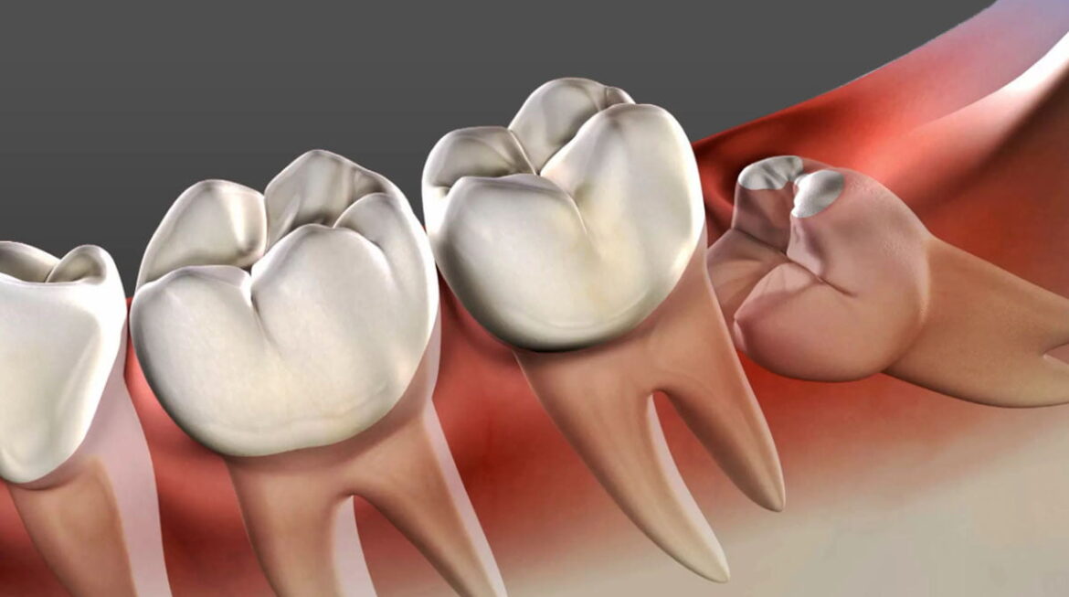 Does Wisdom Tooth Cause Cancer?