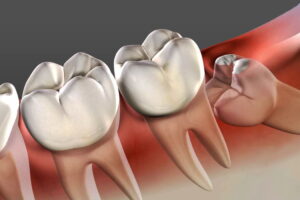 Does Wisdom Tooth Cause Cancer?
