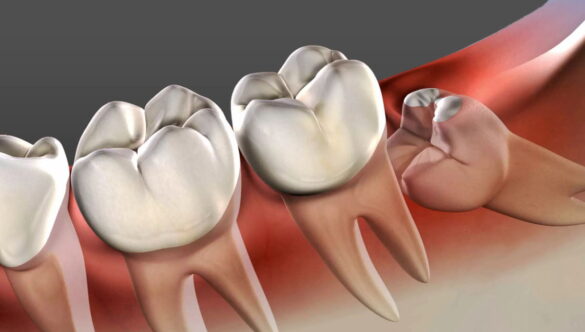 Does Wisdom Tooth Cause Cancer?
