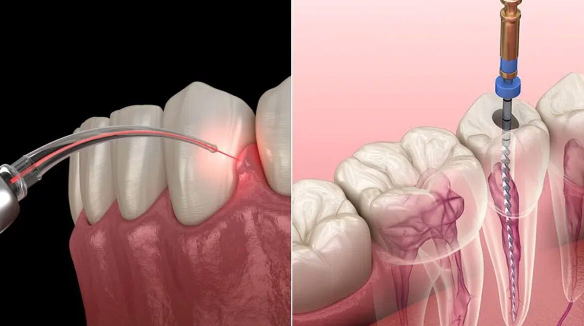 Difference Between Laser and Traditional Root Canal Treatment