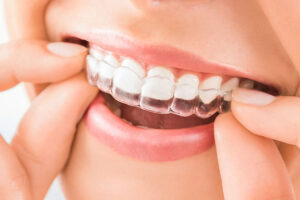 Clear Aligners (Invisalign) V/S Braces: Choosing the Best Treatment for Your Smile