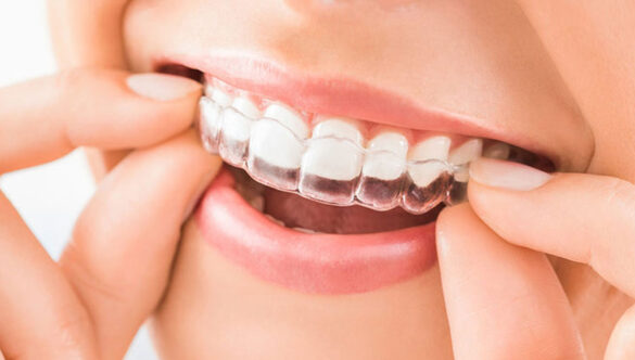 Clear Aligners (Invisalign) V/S Braces: Choosing the Best Treatment for Your Smile