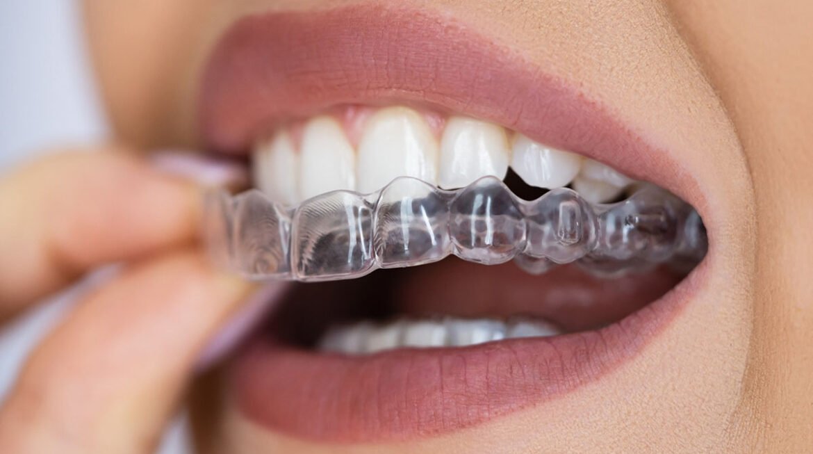 Achieve a Perfect Smile with Invisible Braces in Gandhinagar