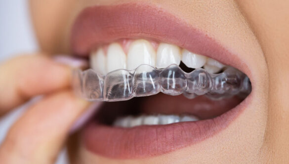 Achieve a Perfect Smile with Invisible Braces in Gandhinagar