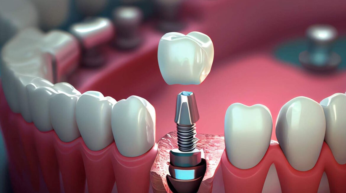 Dental Implant Gandhinagar: A Permanent Solution for Missing Teeth