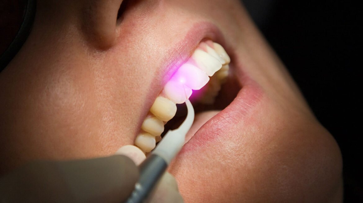 Painless Laser Gum Treatment Gandhinagar: A Gentle Approach to Oral Health