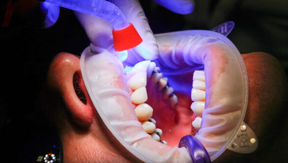 Painless Laser Treatment Gandhinagar: A Modern Approach to Dental Care