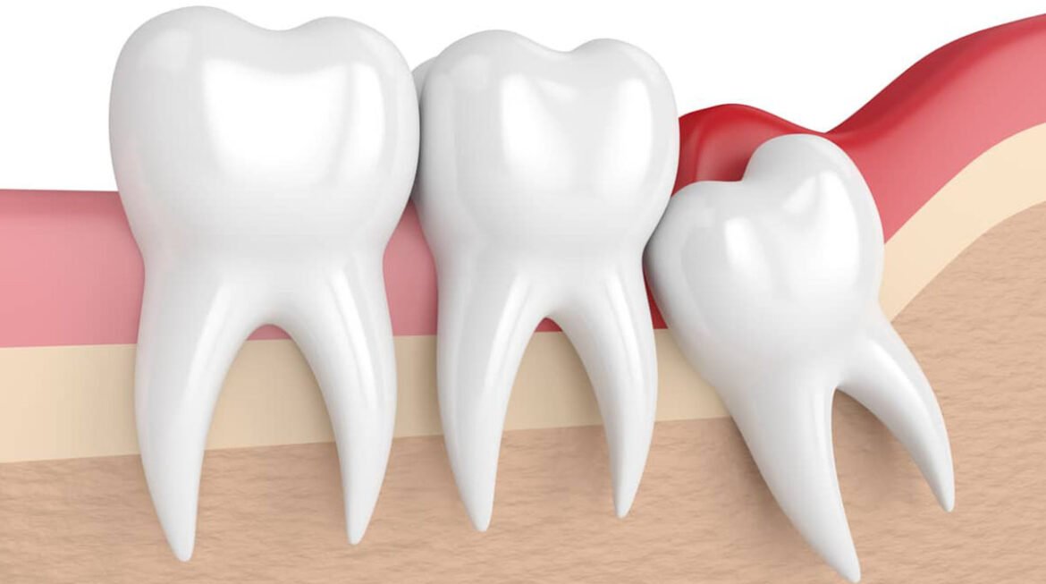 Wisdom Tooth Removal Gandhinagar: A Hassle-Free Solution for Third Molars