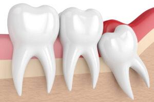 Wisdom Tooth Removal Gandhinagar: A Hassle-Free Solution for Third Molars