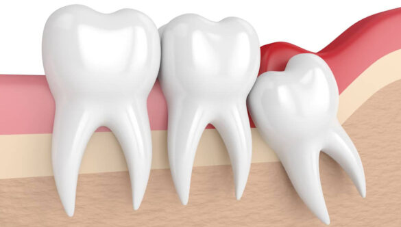 Wisdom Tooth Removal Gandhinagar: A Hassle-Free Solution for Third Molars