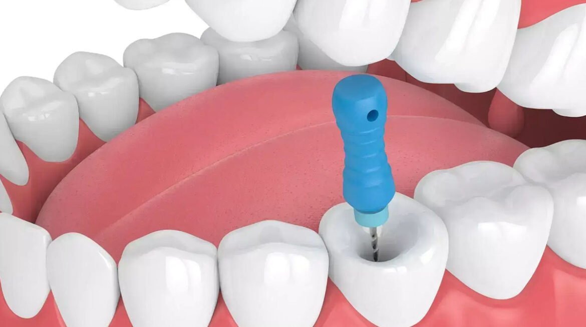 Say Goodbye to Tooth Pain: Experience Painless Root Canal at Nova Dental Hospital