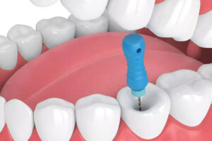 Say Goodbye to Tooth Pain: Experience Painless Root Canal at Nova Dental Hospital